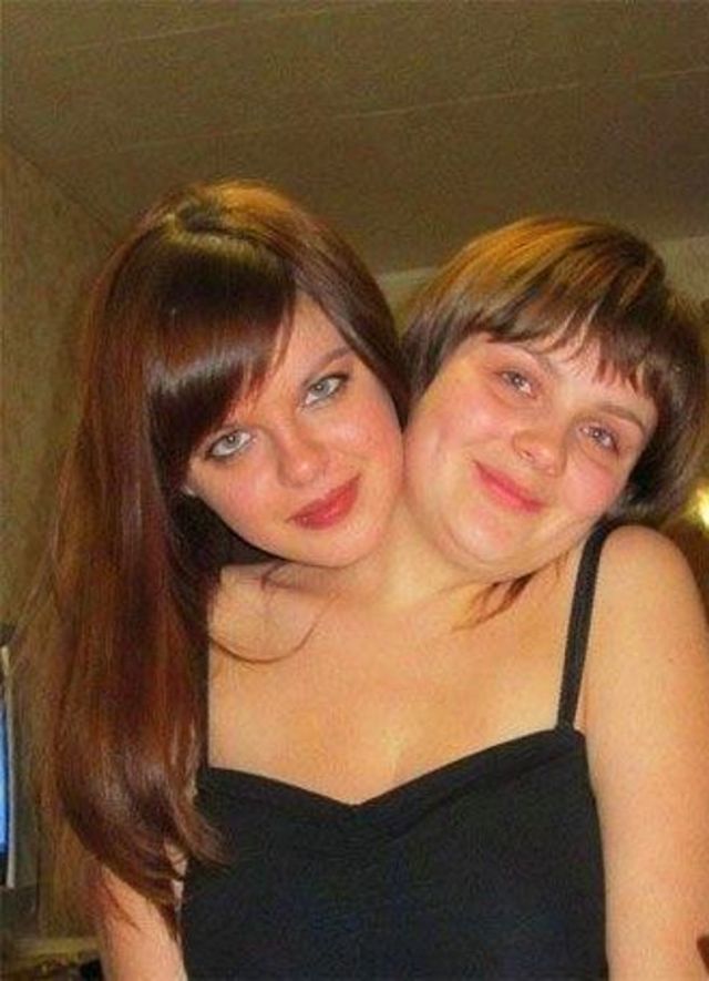 Նորի՞ց սիամական երկվորյակներ